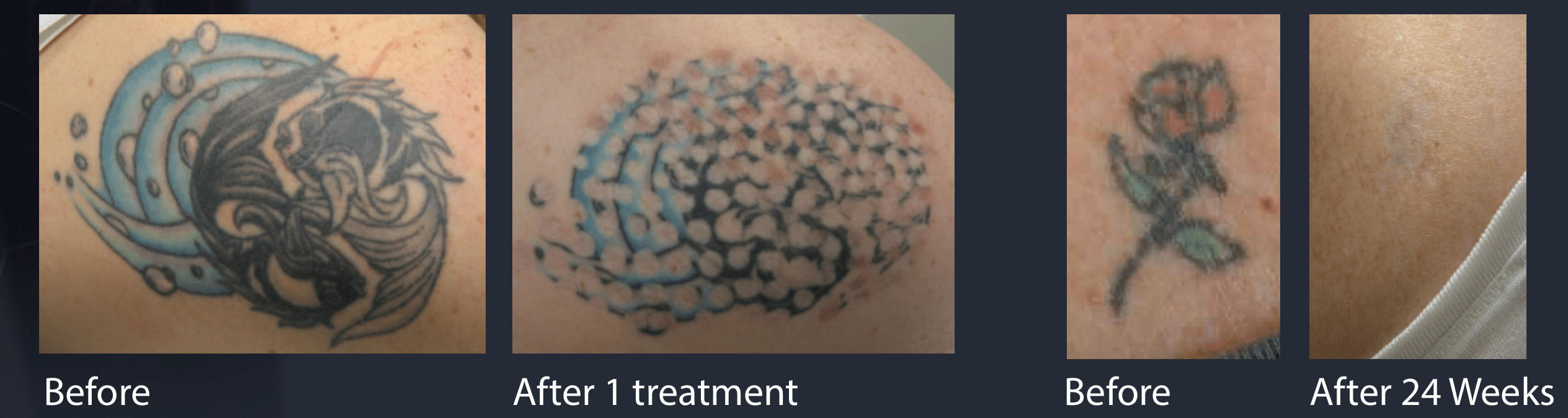 Tattoo Removal - Essential Beauty Medical Spa Foothill Ranch, CA